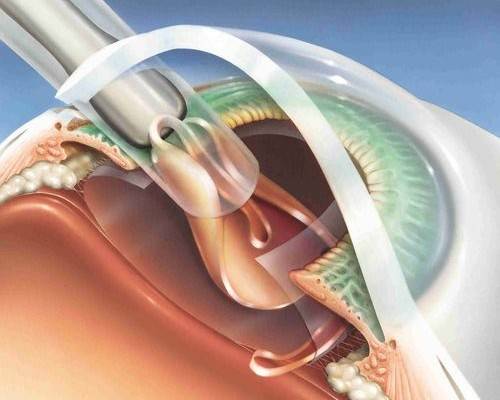 The process of cataract suction during phacoemulsification surgery