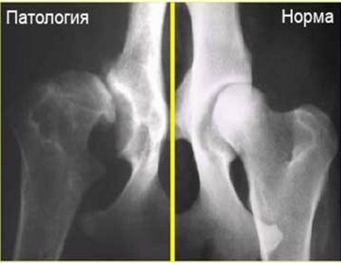 X-ray image of hip dysplasia